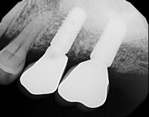 sinus-augmentation-after