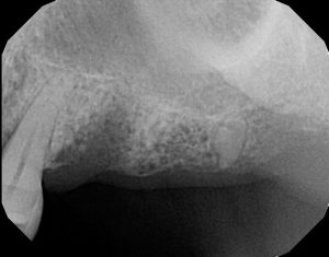 sinus-augmentation-before